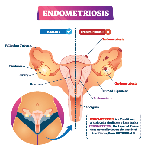 where is endometriosis found