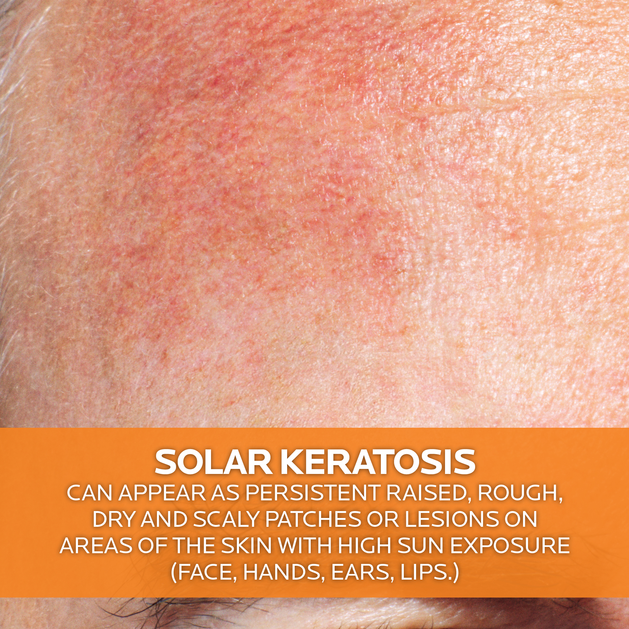 La Roche-Posay Anthelios KA+ Sunscreen SPF50+ - 50ml - Image 7