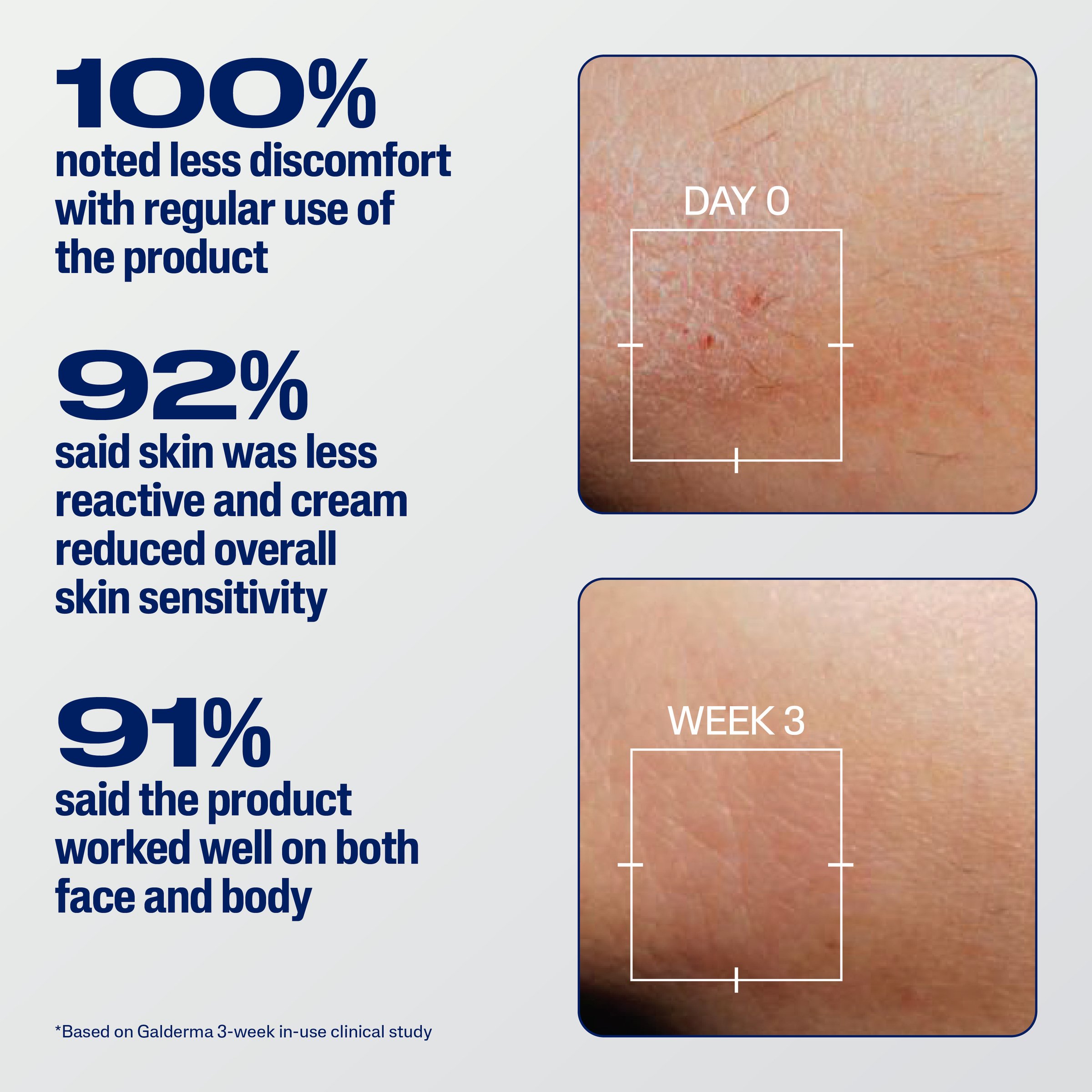 Cetaphil Pro Eczema Prone Soothe & Repair Cream 226g - Image 5