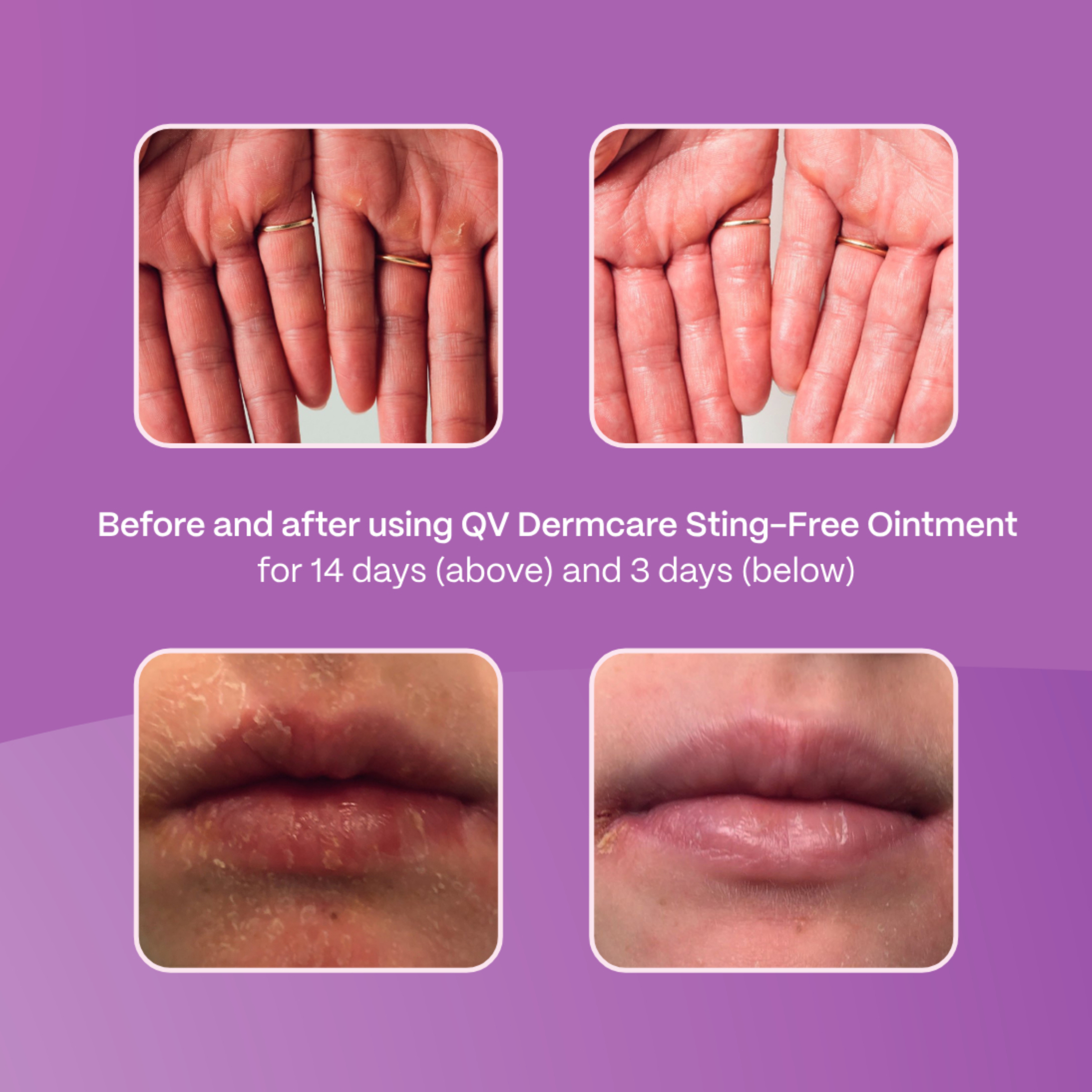 Ego QV Dermcare Sting-Free Ointment 200g - Image 3