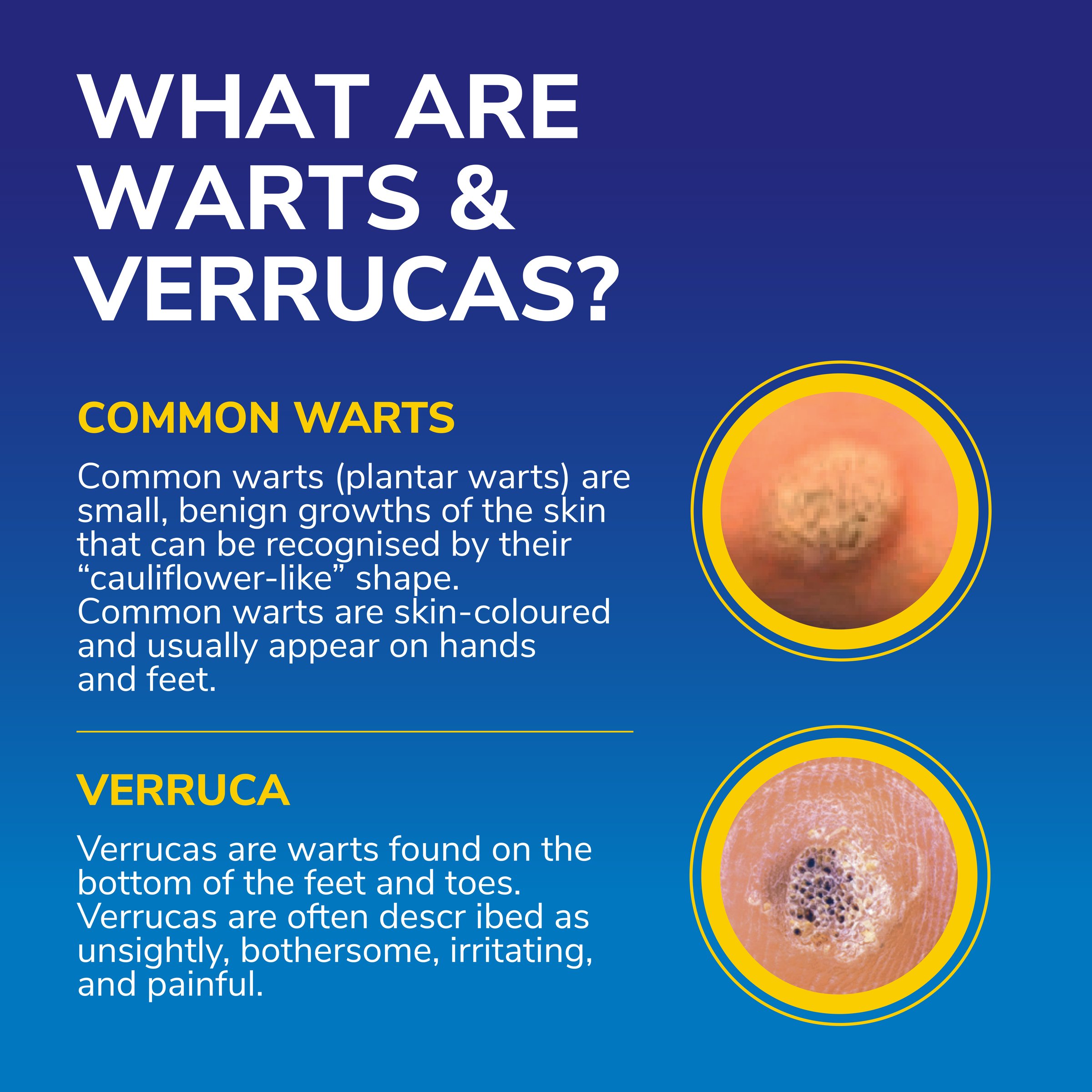 Dr.Scholl's Freeze Away Max Verruca & Wart Remover 1 unit - Image 4